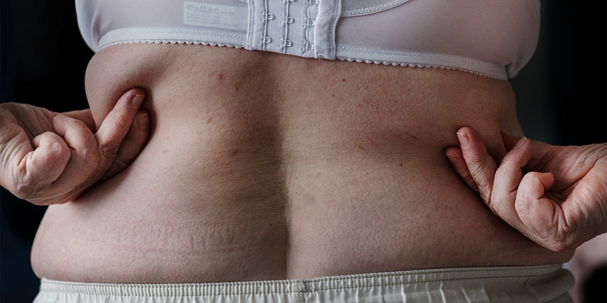 Tratamento para obesidade: o mais adequado para você 2 Mulher de costas precisando de tratamento para obesidade - site Dr. Rodrigo Barbosa cirurgião bariátrico e gastrocirurgião São Paulo - SP