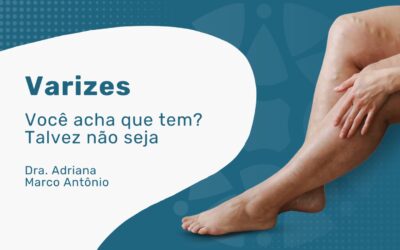 Varizes: o que é, como evitar e como tratar