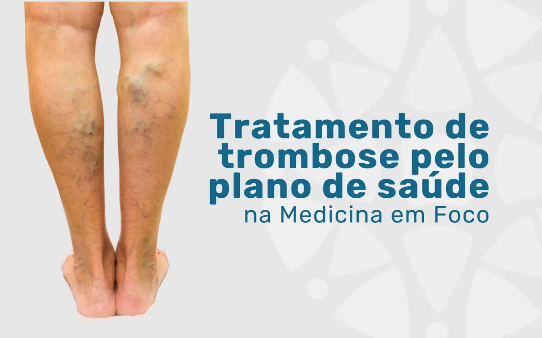 Tratamento de trombose pelo plano de saúde Bradesco