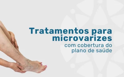 Tratamentos para microvarizes pela Omint Saúde