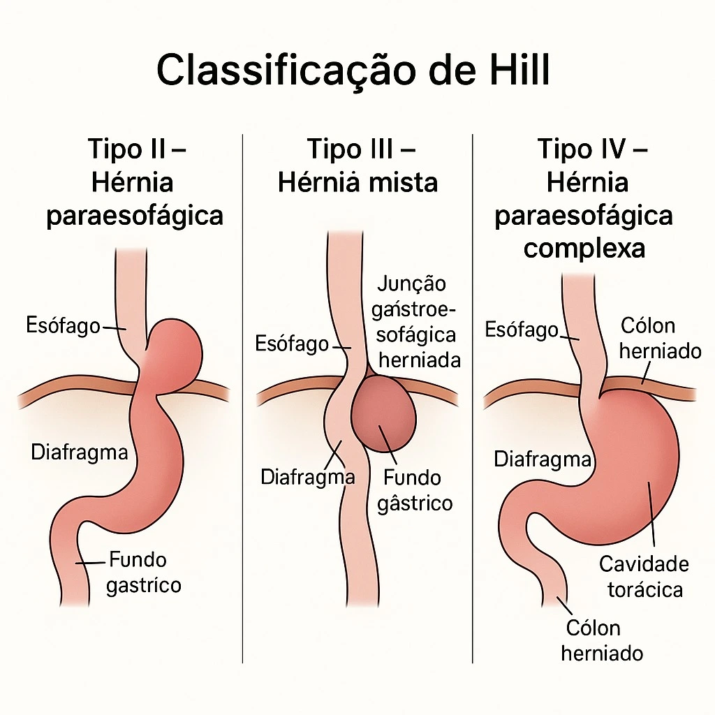Classificação de Hill para Hérnia de Hiato