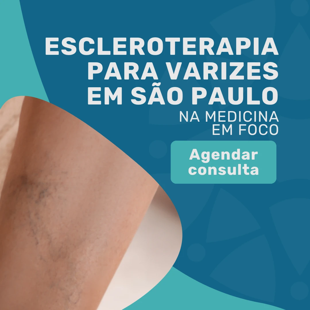 Entre em contato com o Instituto Medicina em foco para saber mais sobre o tratamento Escleroterapia para varizes com Cirurgião Vascular especialista em varizes em são paulo