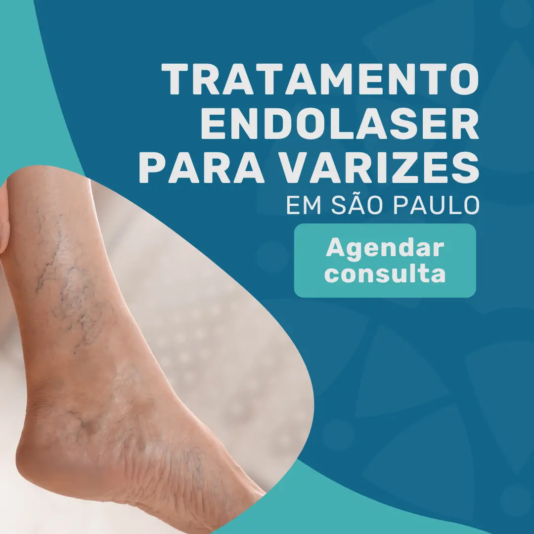 Entre em contato com o Instituto Medicina em foco para saber mais sobre o tratamento endolaser para varizes com Cirurgião Vascular especialista em varizes em são paulo
