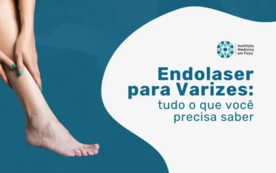 Endolaser: saiba mais sobre esse tratamento para varizes