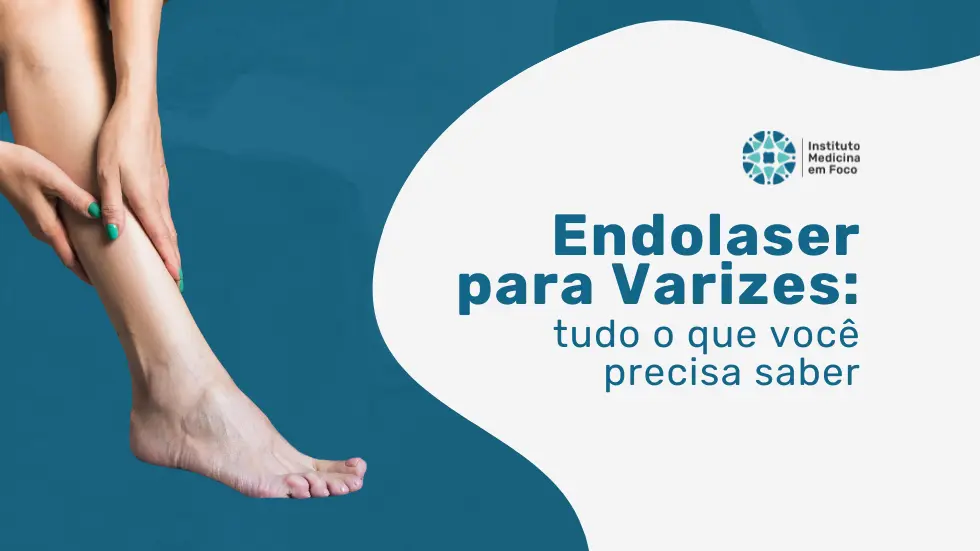 Endolaser: saiba mais sobre esse tratamento para varizes