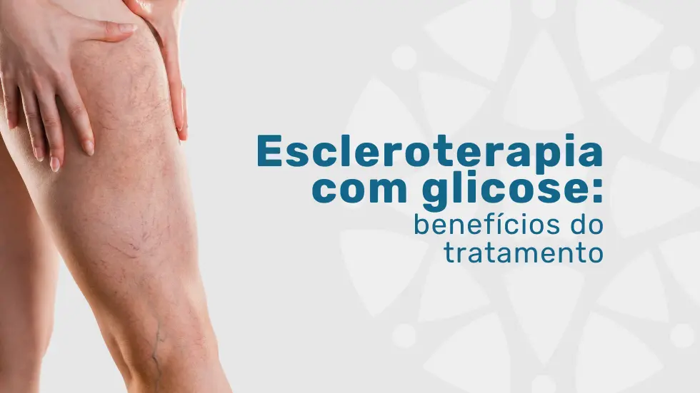 Escleroterapia com glicose: benefícios do tratamento