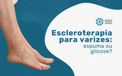 Escleroterapia para varizes: qual é a melhor opção?