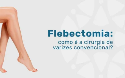 Flebectomia: como é a cirurgia de varizes convencional?