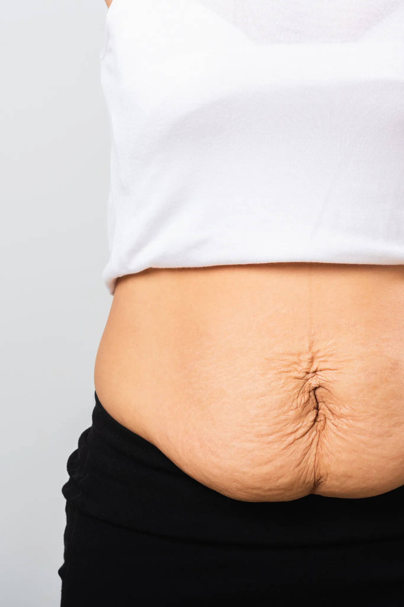 1 Abdominoplastia ANTES