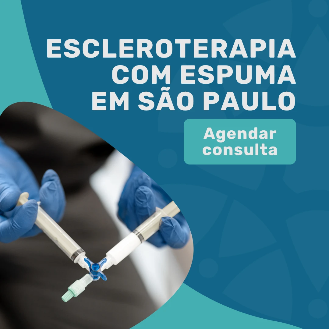 Entre em contato com o Instituto Medicina em foco para uma consulta angiologista em são paulo para tratamento para varizes com a escleroterapia com espuma