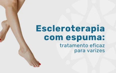 Escleroterapia com espuma: o tratamento eficaz para varizes