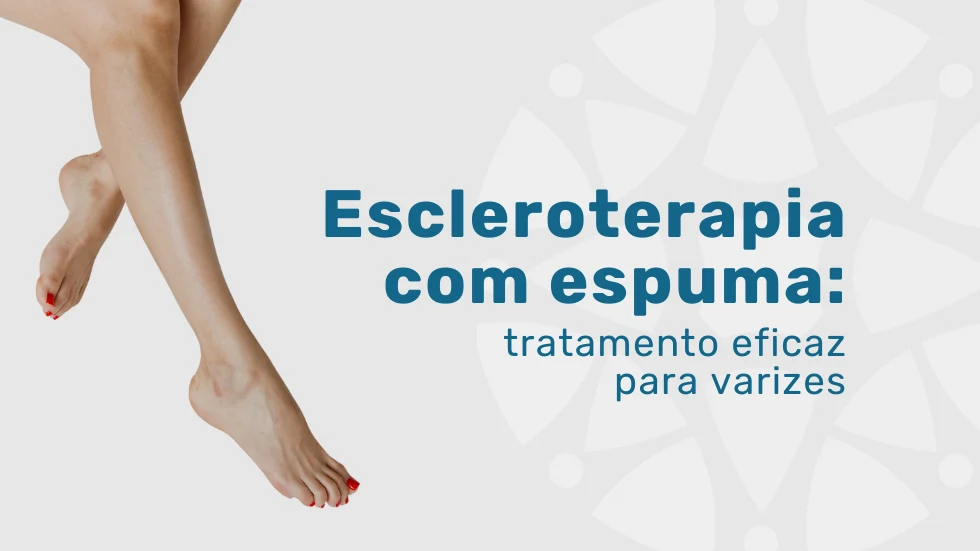 Foam sclerotherapy: the effective treatment for varicose veins