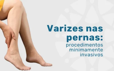 Varizes nas pernas: procedimentos minimamente invasivos