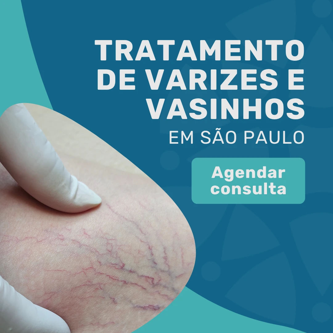 Entre em contato com o Instituto Medicina em foco para agendar uma consulta com Angiologista em São Paulo para realizar um tratamento para varizes e vasinhos