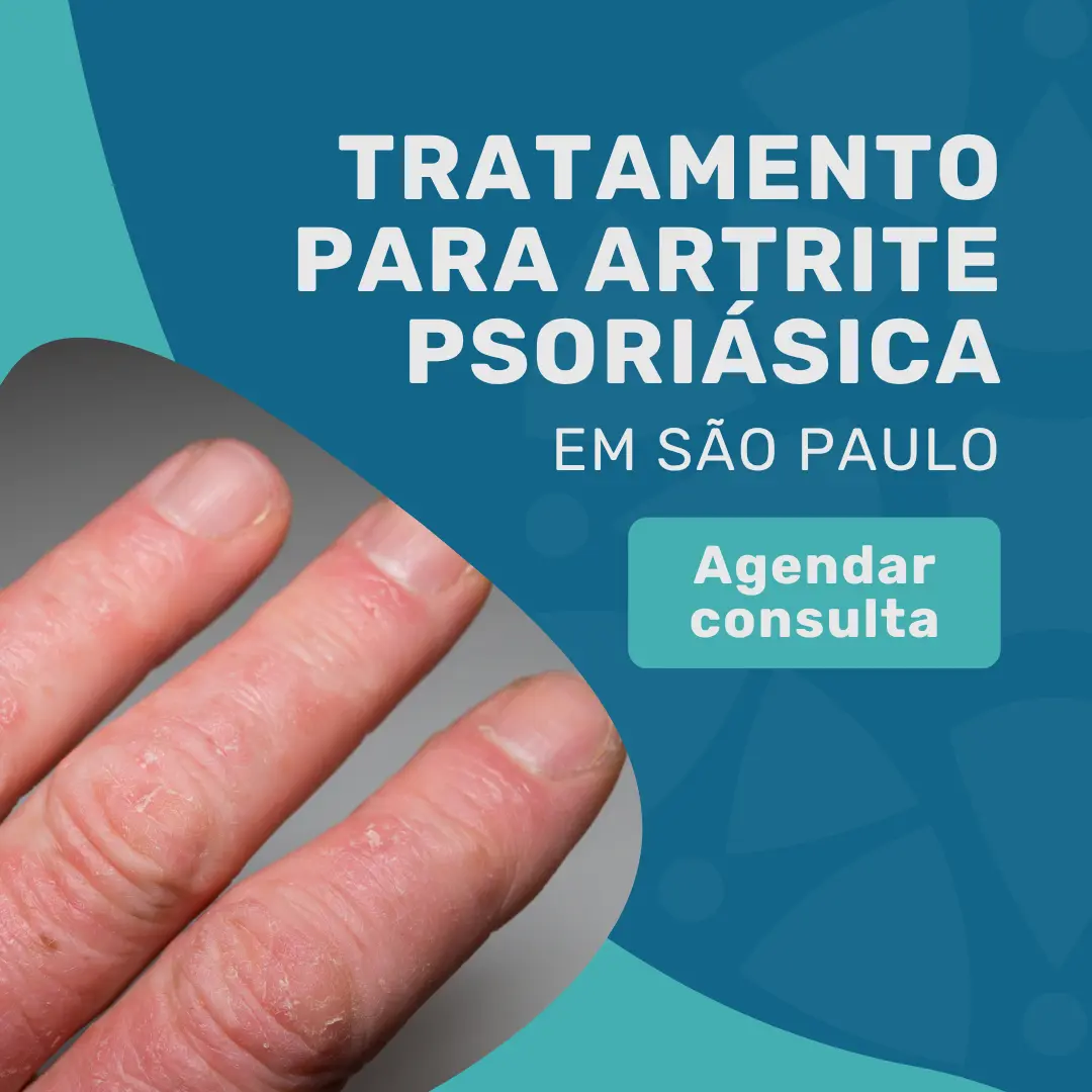 Entre em contato com o Instituto Medicina em foco para agendar uma consulta com reumatologista em São Paulo e fazer tratamento para Artrite psoriásica