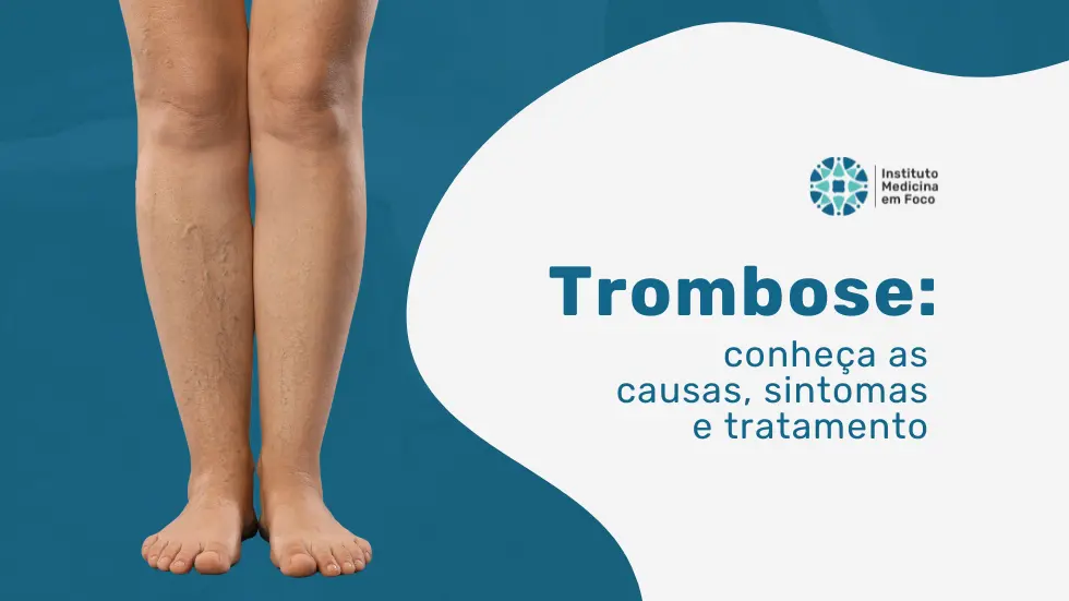 Trombose: sintomas, causas e diagnóstico vascular