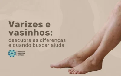 Varizes e vasinhos: saiba a diferença e busque ajuda médica