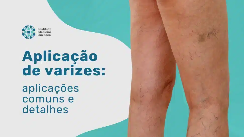 MEF - Aplicação de varizes aplicações comuns e detalhes