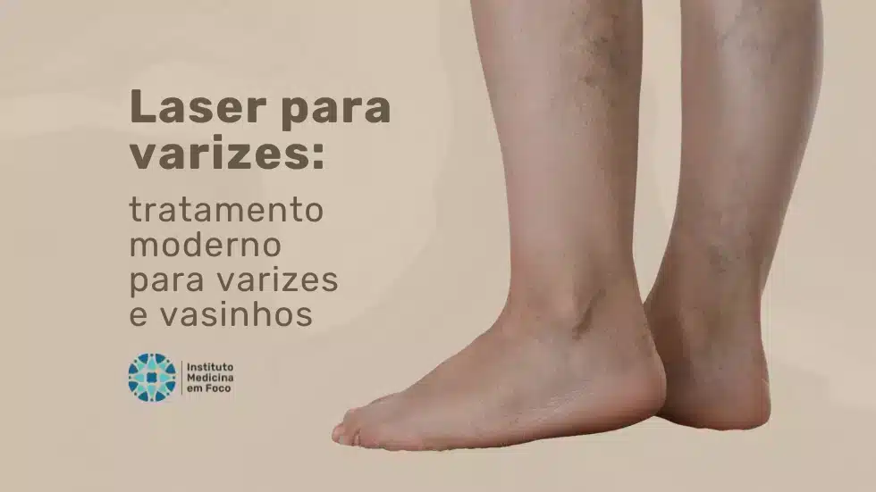MEF - Laser para varizes tratamento para varizes e vasinhos