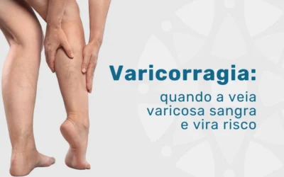 Home 7 Varicorragia: quando o sangramento das varizes é perigoso