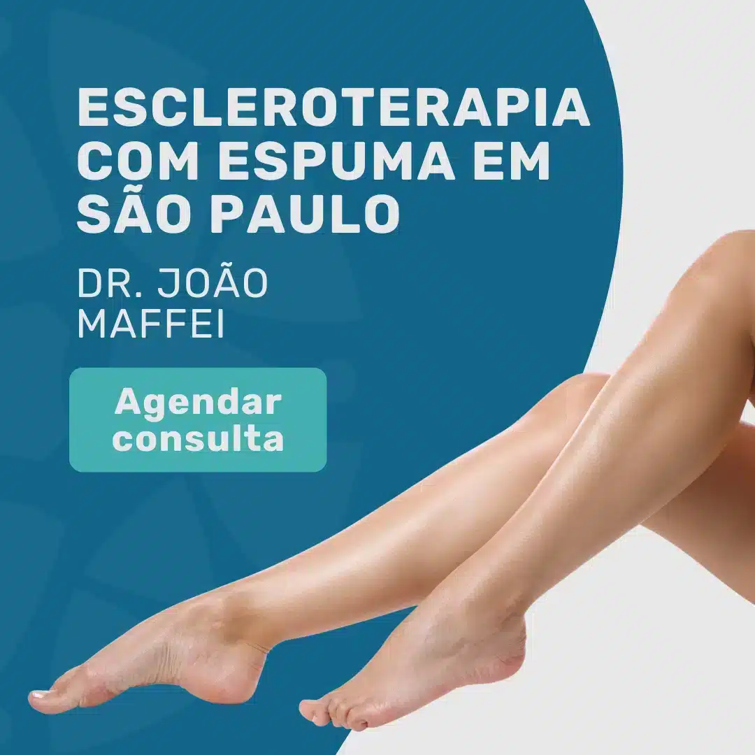 Escleroterapia com espuma: tratamento seguro para varizes 2 Entre em contato com o Insituto Medicina em Foco para agendar sua consulta com o Dr. João Maffei, Angiologista e Cirurgião Vascular em São Paulo, para realizar escleroterapia com espuma para variz