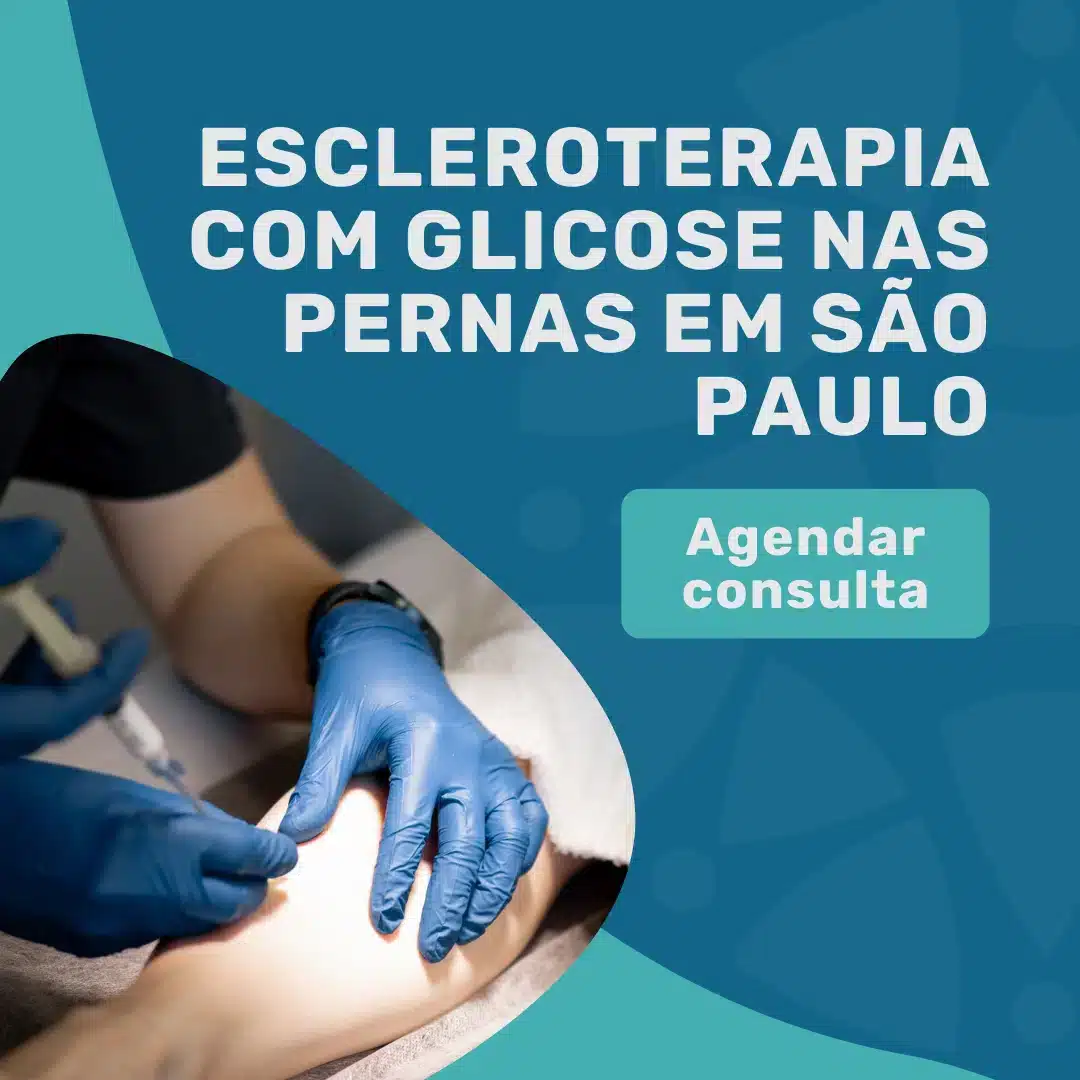 Entre em contato para agendar sua consulta com o Dr. João Maffei, cirurgião vascular em São Paulo, para escleroterapia com glicose nas pernas