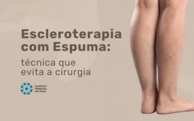 Home 7 Escleroterapia com espuma evita cirurgia de varizes?