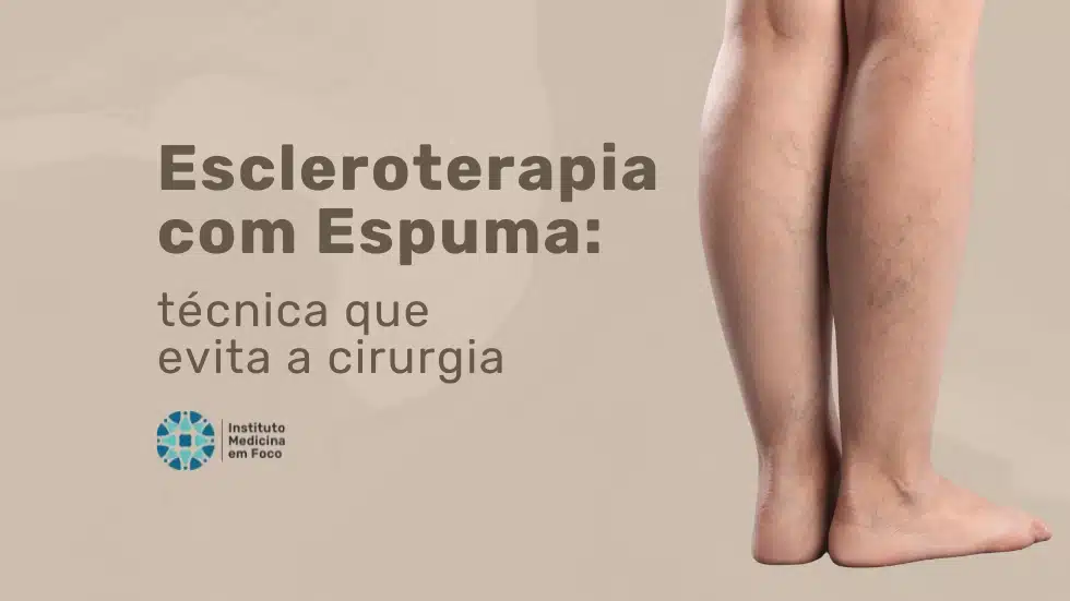 Arquivo medicina em foco 31 MEF - Escleroterapia com espuma evita cirurgia de varizes