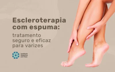 Home 8 Escleroterapia com espuma: tratamento seguro para varizes