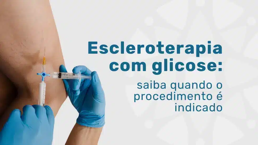 Arquivo medicina em foco 28 MEF - Escleroterapia com glicose não falha o erro é a indicação
