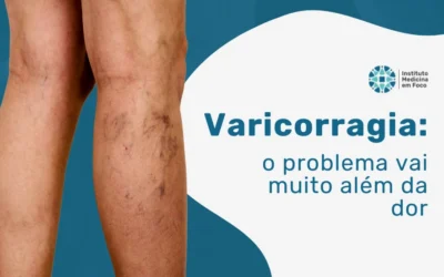 Home 7 Varicorragia: o problema das varizes vai muito além da dor