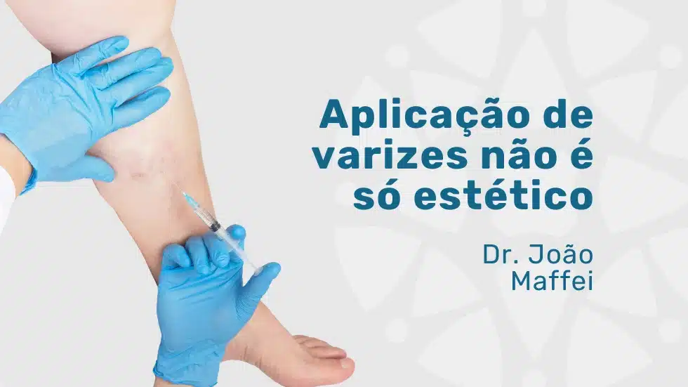 Aplicação de varizes além do tratamento estético