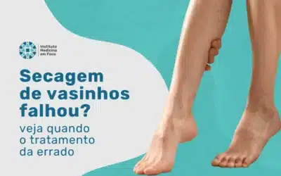Home 7 Secagem de vasinhos no tratamento para varizes pode falhar?