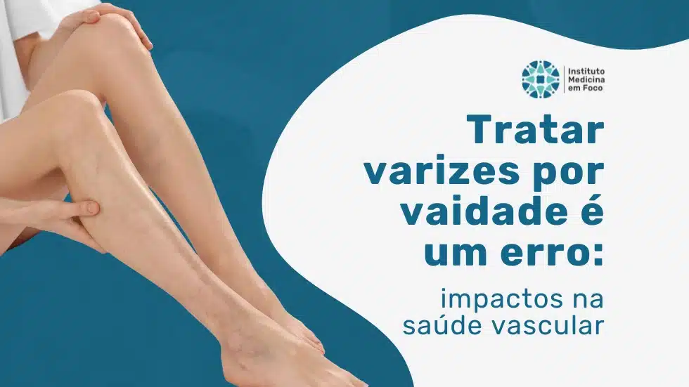 Tratar varizes por vaidade é um erro: entenda os impactos