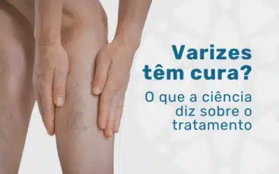Varizes têm cura? O que a medicina vascular atual diz
