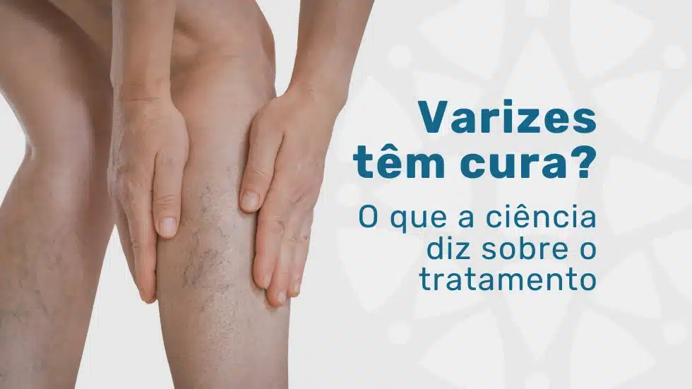 Varizes têm cura? O que a ciência diz sobre o tratamento