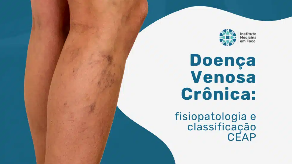 Doença Venosa Crônica: refluxo e classificação CEAP
