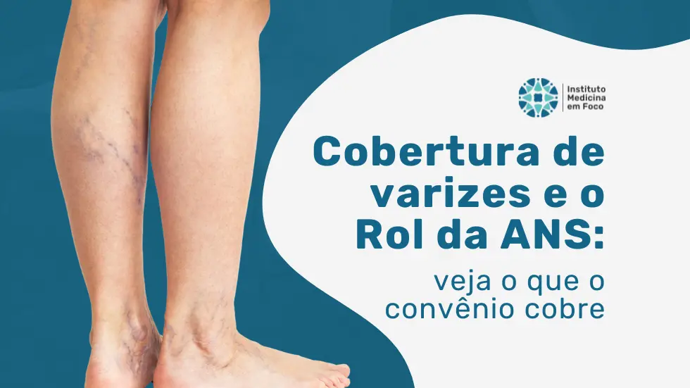Cobertura de varizes e o Rol da ANS: o que o convênio cobre