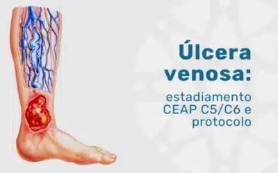 Úlcera venosa: estadiamento CEAP C5/C6 e tratamento