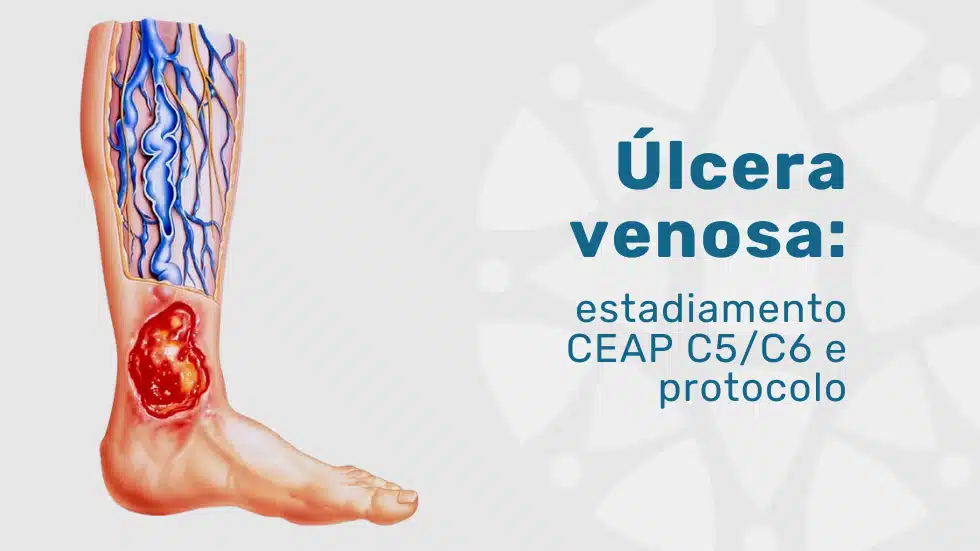 Úlcera venosa: estadiamento CEAP C5/C6 e tratamento